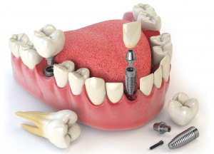 dental-implants